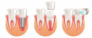 dental implant services in Lahore