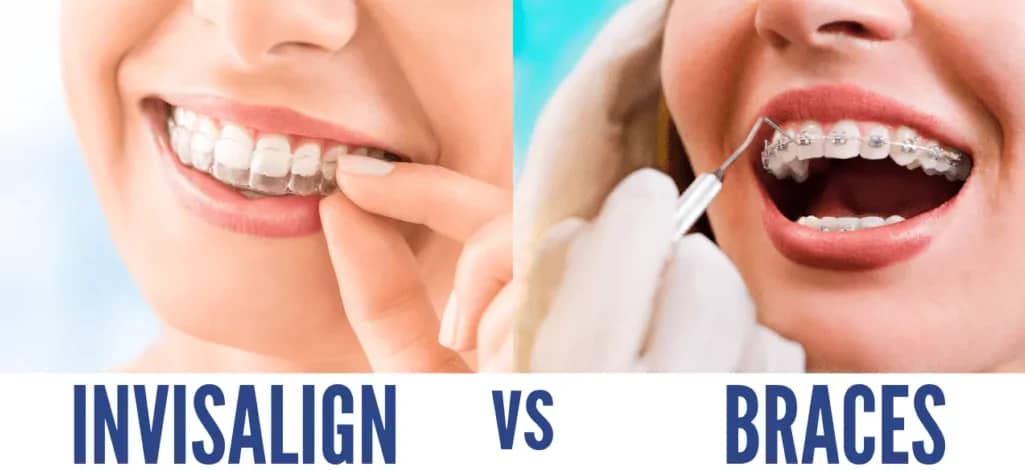 Braces vs Invisalign: Which is Right for Your Teeth?