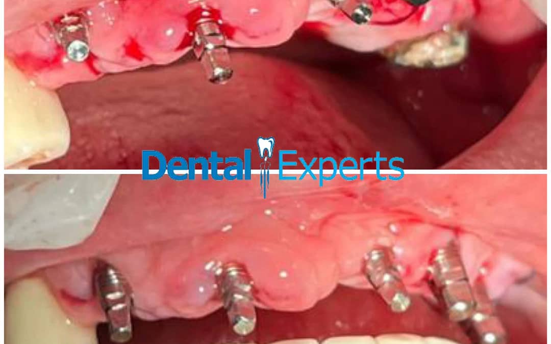 Root Canal Treatment Cost in Lahore