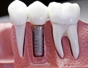 Dental Implants surgery in Lahore by Dental Experts